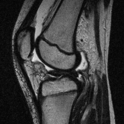 File:Anterior cruciate ligament avulsion fracture (Radiopaedia 24710-24974 Sagittal T2 10).jpg