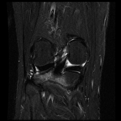 File:Anterior cruciate ligament avulsion fracture (Radiopaedia 58939-66193 Coronal STIR 14).jpg