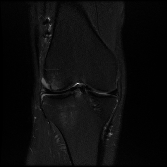 File:Anterior cruciate ligament graft tear and bucket-handle tear of medial meniscus (Radiopaedia 75867-87254 Coronal PD fat sat 11).jpg