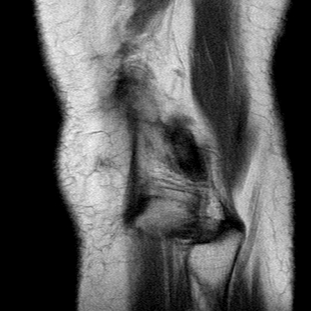 File:Anterior cruciate ligament mucoid degeneration (Radiopaedia 60853-68633 Sagittal PD 26).jpg