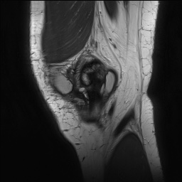 Anterior cruciate ligament rupture with Segond fracture (Radiopaedia 69043-78806 Sagittal PD 29).jpg