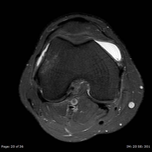 File:Anterior cruciate ligament tear (Radiopaedia 70783-80964 Axial PD fat sat 20).jpg