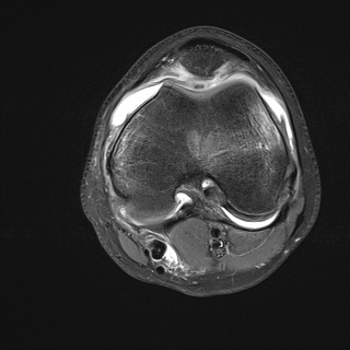File:Anterior cruciate ligament tear - pediatric (Radiopaedia 62152-70260 Axial PD fat sat 17).jpg