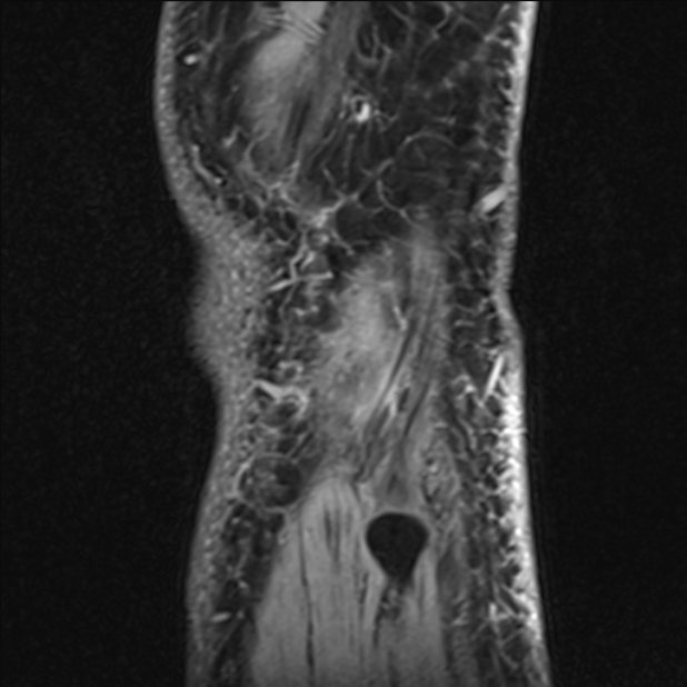 Anterior cruciate ligament tear - ramp lesion (Radiopaedia 71883-82322 Sagittal T1 vibe 12).jpg