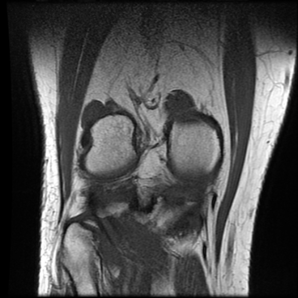 File:Anterior cruciate ligament tear with posteromedial corner injury, bucket-handle meniscal tear and chondral delamination (Radiopaedia 75501-86744 Coronal T1 20).jpg
