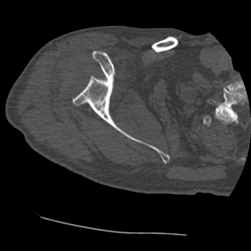 Anterior glenohumeral dislocation with Hill-Sachs lesion (Radiopaedia 62877-71249 Axial bone window 29).jpg