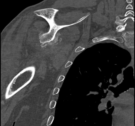 Anterior glenohumeral dislocation with Hill-Sachs lesion (Radiopaedia 62877-71249 Coronal bone window 66).jpg