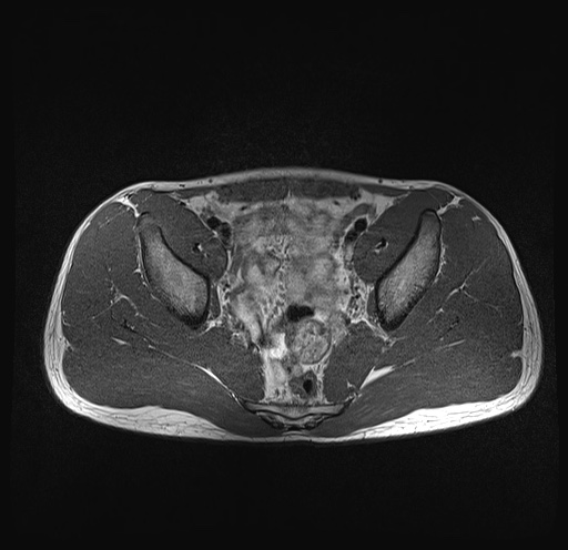 File:Anterior inferior iliac spine avulsion fracture (Radiopaedia 81312-95000 Axial T1 26).jpg