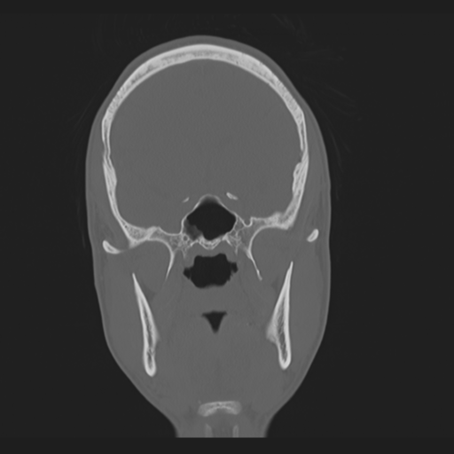 File:Anterior nasal spine fracture (Radiopaedia 46138-50494 Axial bone window 1).png