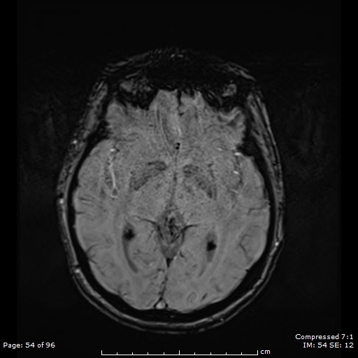 Anterior temporal lobe perivascular space (Radiopaedia 88283-104914 Axial SWI 23).jpg