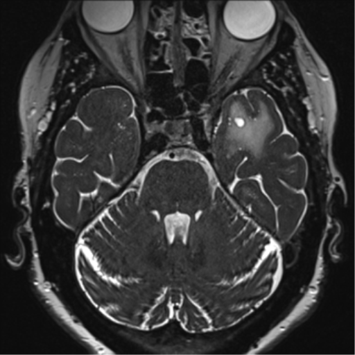 Anterior temporal pole cysts (Radiopaedia 46629-51102 Axial 24).png