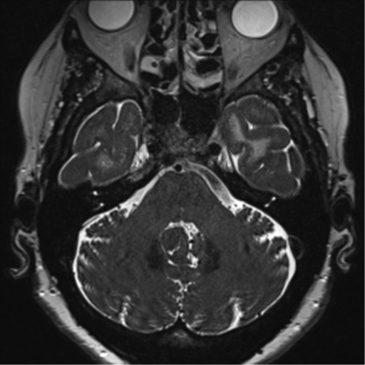 Anterior temporal pole cysts (Radiopaedia 46629-51102 Axial 9).png