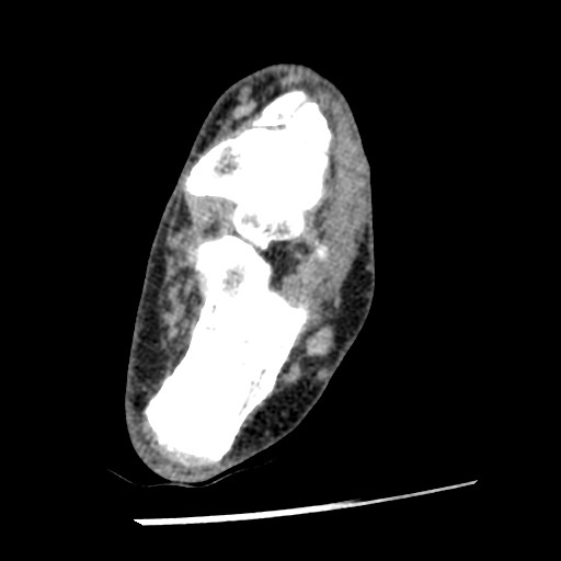 Anterior tibial artery false aneurysm (Radiopaedia 88984-105809 A 171).jpg