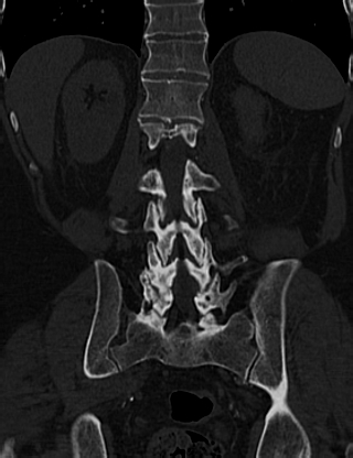 Anterior vertebral scalloping (abdominal aortic aneurysm) (Radiopaedia 66744-76067 Coronal bone window 49).jpg