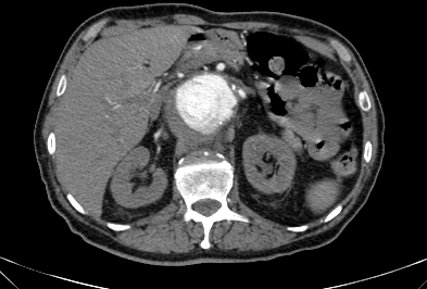 File:Anterior vertebral scalloping (abdominal aortic aneurysm) (Radiopaedia 66744-76067 F 16).jpg