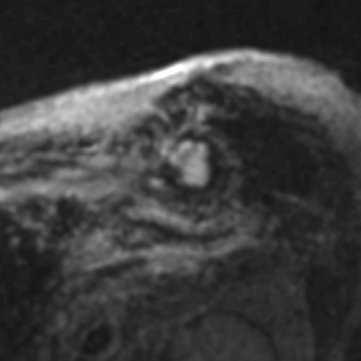 File:Anteroseptal hypokinesia after myocardial infarction (Radiopaedia 15978-15633 I 7).jpg