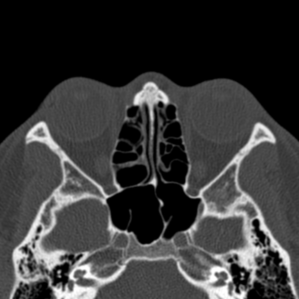 Antrochoanal polyp (Radiopaedia 33984-35202 Axial bone window 48).jpg