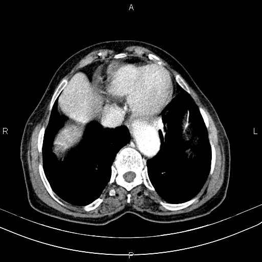 Aortic aneurysm and Lemmel syndrome (Radiopaedia 86499-102554 A 10).jpg