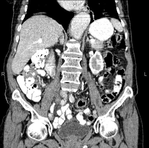 Aortic aneurysm and Lemmel syndrome (Radiopaedia 86499-102554 C 32).jpg