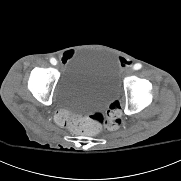 File:Aortic aneurysm with spinal destruction (Radiopaedia 42301-45410 A 99).jpg