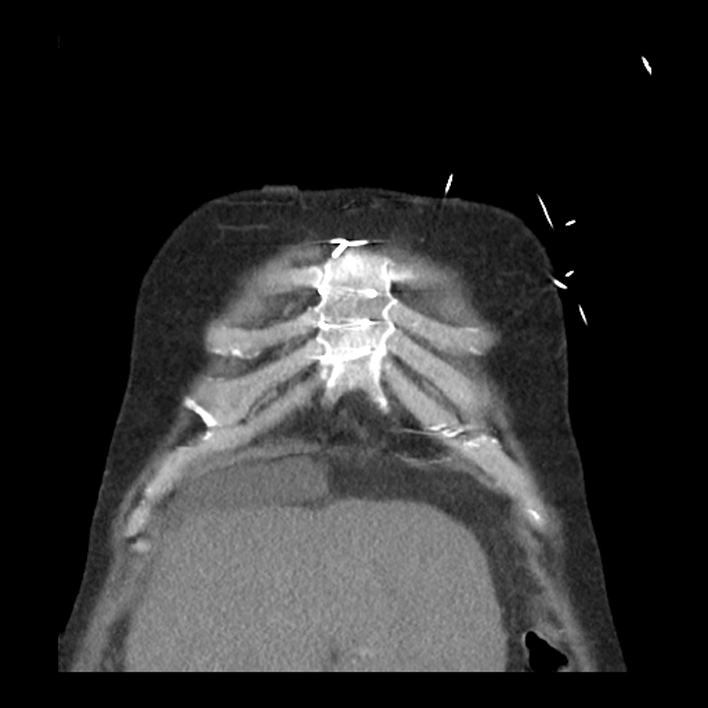 Aortic arch graft infection (FDG PET-CT) (Radiopaedia 71975-82437 Coronal 10).jpg
