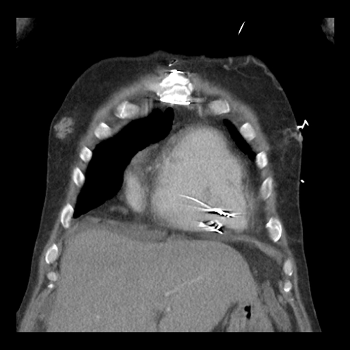 Aortic arch graft infection (FDG PET-CT) (Radiopaedia 71975-82437 Coronal 15).jpg