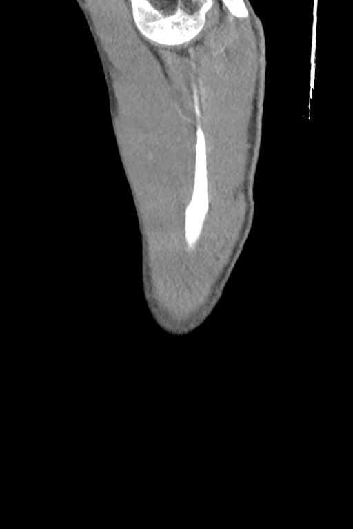 Aortic coarctation with aneurysm (Radiopaedia 74818-85828 B 4).jpg