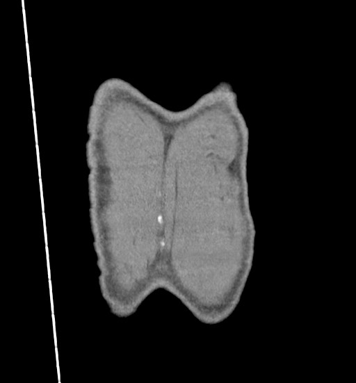 Aortic coarctation with aneurysm (Radiopaedia 74818-85828 C 118).jpg