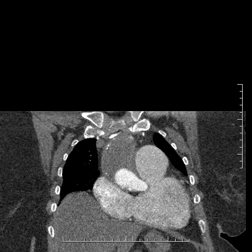File:Aortic dissection- Stanford A (Radiopaedia 35729-37268 E 56).jpg