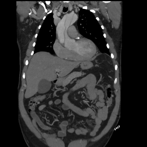 File:Aortic dissection- Stanford A (Radiopaedia 37759-39664 Coronal C+ delayed 15).png