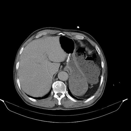 File:Aortic dissection- Stanford type A (Radiopaedia 22085-22085 Axial C+ delayed 10).jpg