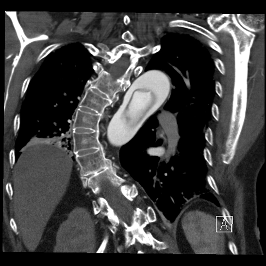 Aortic dissection (CTPA) (Radiopaedia 75506-86750 B 55).jpg