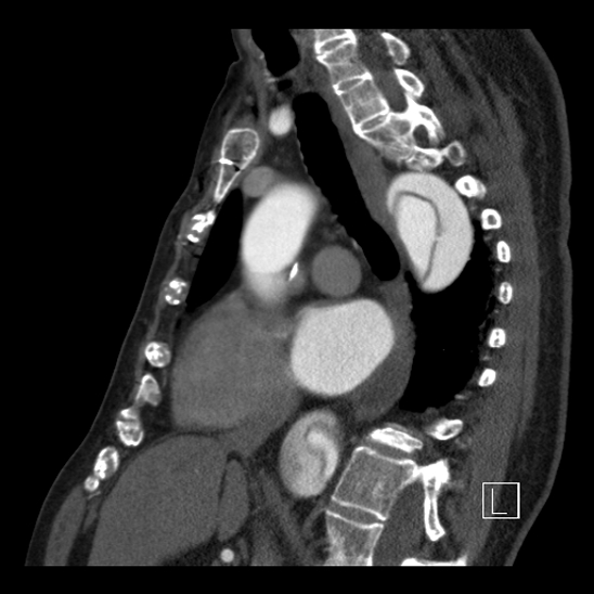 File:Aortic dissection (CTPA) (Radiopaedia 75506-86750 C 54).jpg