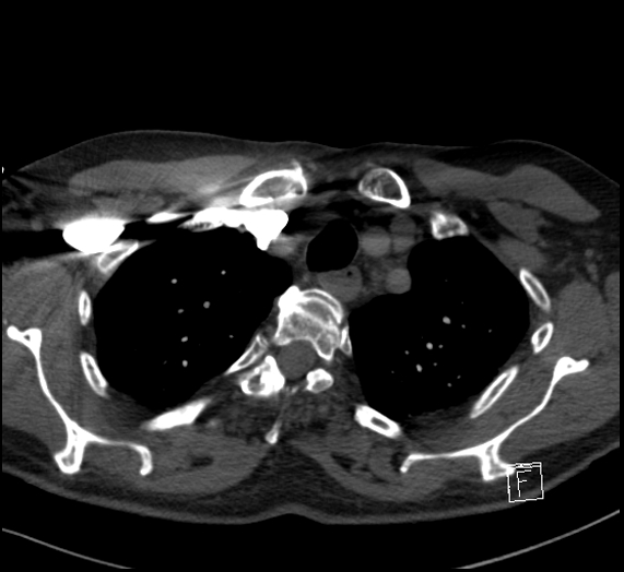 Aortic dissection (CTPA) (Radiopaedia 75506-86751 Axial C+ CTPA 25).jpg