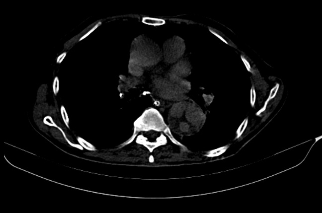 File:Aortic dissection (Mercedes-Benz sign) (Radiopaedia 12254).jpg