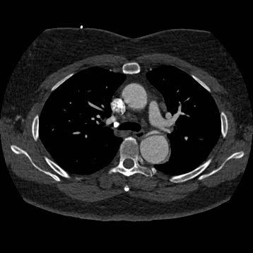 Aortic dissection (Radiopaedia 57969-64959 A 121).jpg