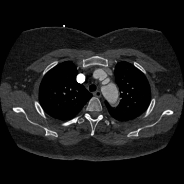 Aortic dissection (Radiopaedia 57969-64959 A 81).jpg