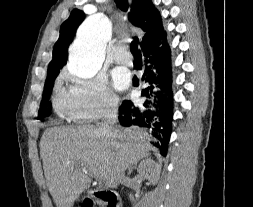 Aortic dissection - Stanford A -DeBakey I (Radiopaedia 28339-28587 C 5).jpg