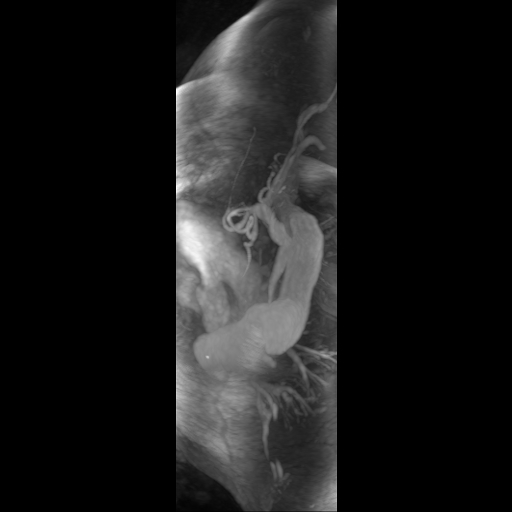 File:Aortic dissection - Stanford A - DeBakey I (Radiopaedia 23469-23551 D 14).jpg