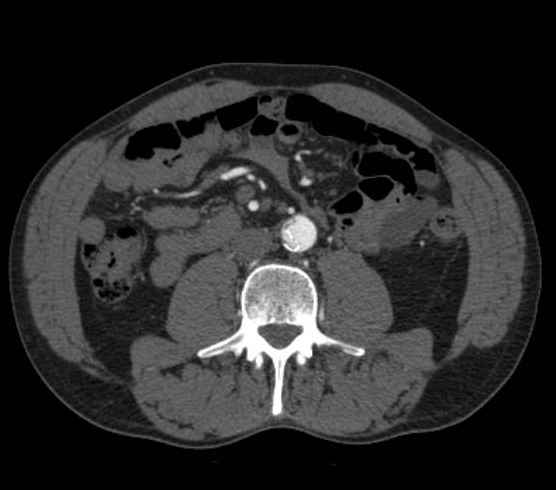 Aortic dissection - Stanford type B (Radiopaedia 73648-84437 A 173).jpg