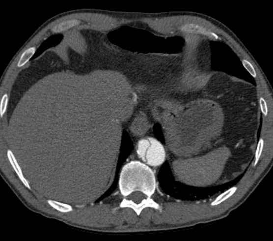 Aortic dissection - Stanford type B (Radiopaedia 73648-84437 A 98).jpg