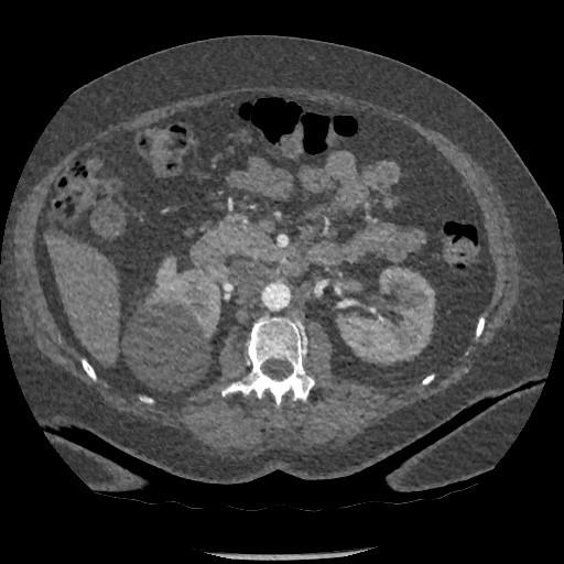 File:Aortic dissection - Stanford type B (Radiopaedia 88281-104910 A 116).jpg