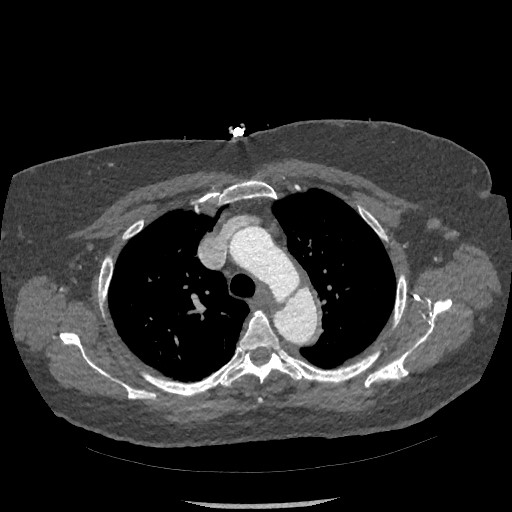 File:Aortic dissection - Stanford type B (Radiopaedia 88281-104910 A 17).jpg