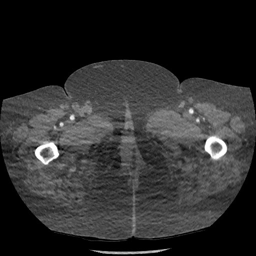 Aortic dissection - Stanford type B (Radiopaedia 88281-104910 A 172).jpg