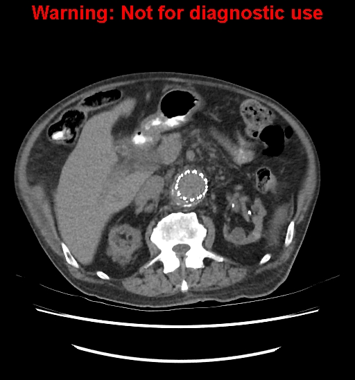 Aortic graft infection (Radiopaedia 44979-48907 Axial non-contrast 40).jpg
