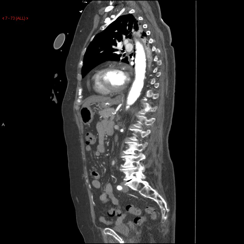 Aortic intramural hematoma (Radiopaedia 27746-28001 C 42).jpg