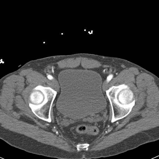 Aortic intramural hematoma (Radiopaedia 31139-31838 B 159).jpg