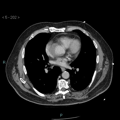 File:Aortic intramural hematoma (Radiopaedia 48463-53380 C 92).jpg