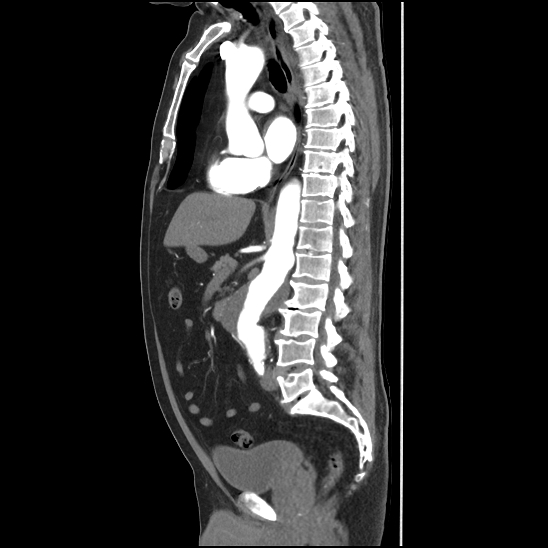 Aortic intramural hematoma (type B) (Radiopaedia 79323-92387 H 26).jpg