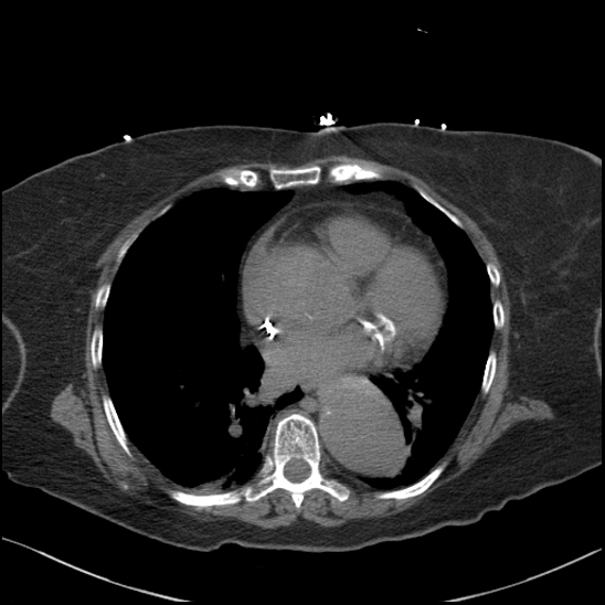 File:Aortic intramural hematoma with dissection and intramural blood pool (Radiopaedia 77373-89491 Axial non-contrast 57).jpg